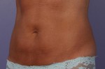 CoolSculpting® Before and after photo