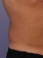 CoolSculpting® Before and after photo