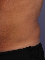 CoolSculpting® Before and after photo