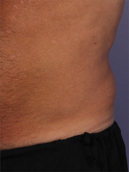 CoolSculpting® before and after photo