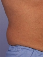 CoolSculpting® Before and after photo