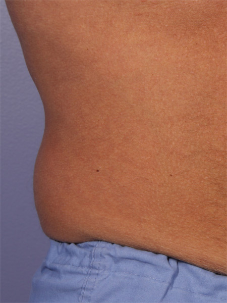 CoolSculpting® before and after photo