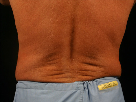 CoolSculpting® before and after photo