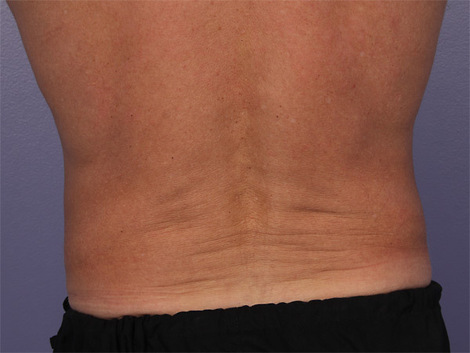 CoolSculpting® before and after photo