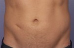 CoolSculpting® Before and after photo