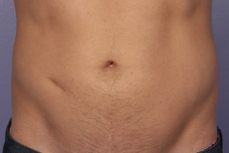 CoolSculpting® before and after photo