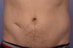 CoolSculpting® Before and after photo