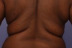 CoolSculpting® Before and after photo