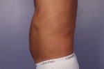 CoolSculpting® Before and after photo