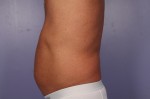 CoolSculpting® Before and after photo