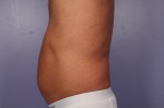 CoolSculpting®