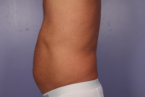 CoolSculpting® before and after photo
