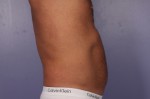 CoolSculpting® Before and after photo