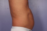 CoolSculpting® Before and after photo