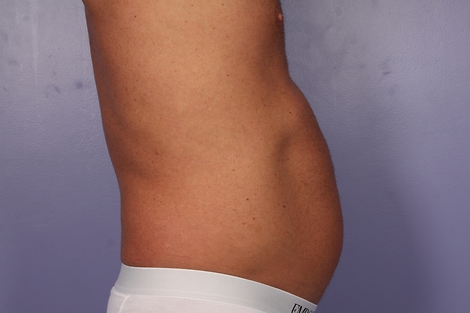 CoolSculpting® before and after photo