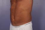 CoolSculpting® Before and after photo