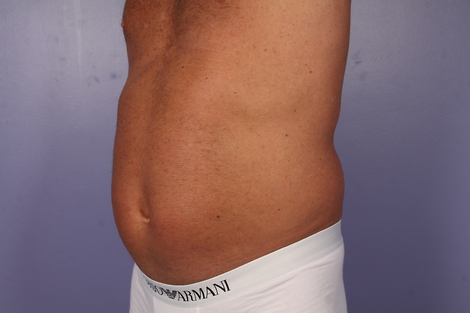 CoolSculpting® before and after photo