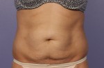 CoolSculpting® Before and after photo