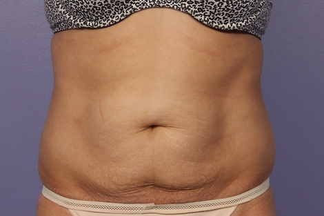 CoolSculpting® before and after photo