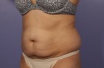 CoolSculpting® Before and after photo