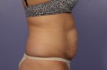 CoolSculpting® Before and after photo