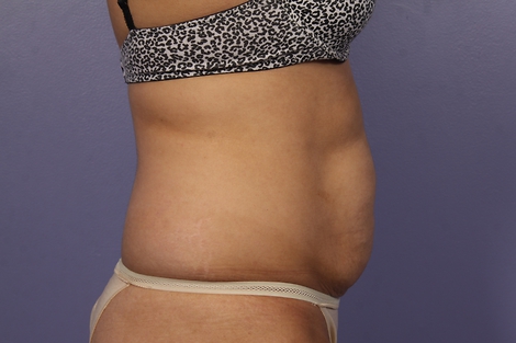 CoolSculpting® before and after photo