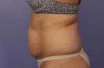 CoolSculpting® Before and after photo