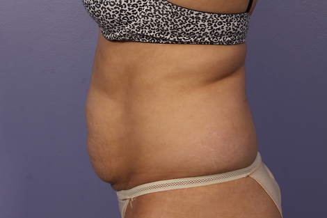 CoolSculpting® before and after photo