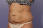 CoolSculpting® Before and after photo