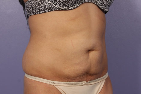 CoolSculpting® before and after photo