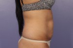 CoolSculpting® Before and after photo