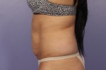 CoolSculpting® Before and after photo