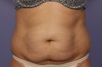 CoolSculpting® Before and after photo