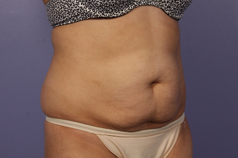 CoolSculpting® before and after photo