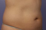 CoolSculpting® Before and after photo