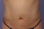 CoolSculpting®
