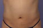 CoolSculpting® Before and after photo