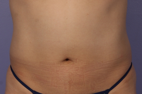 CoolSculpting® before and after photo