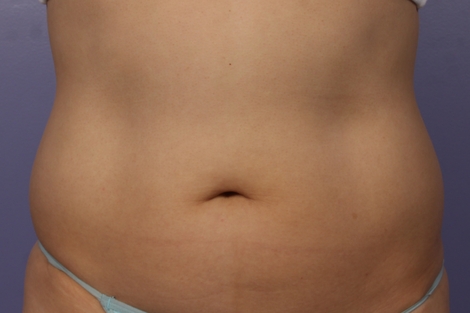 CoolSculpting® before and after photo