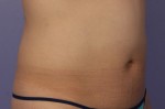 CoolSculpting® Before and after photo