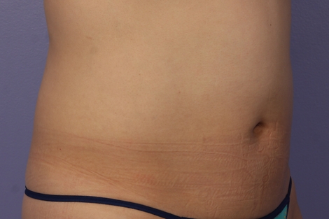 CoolSculpting® before and after photo