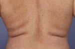 CoolSculpting® Before and after photo