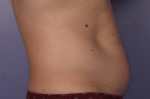 CoolSculpting® Before and after photo