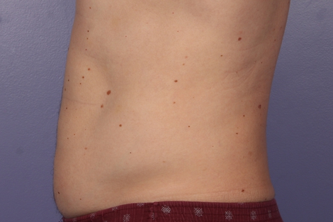 CoolSculpting® before and after photo