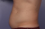 CoolSculpting® Before and after photo