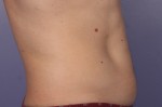 CoolSculpting® Before and after photo