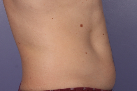 CoolSculpting® before and after photo