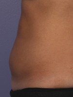 CoolSculpting® Before and after photo