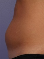 CoolSculpting® Before and after photo