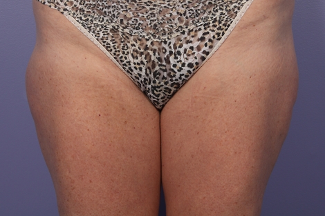 CoolSculpting® before and after photo